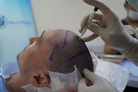 Blue Magic Hair Transplant: A Game-Changer in the Industry